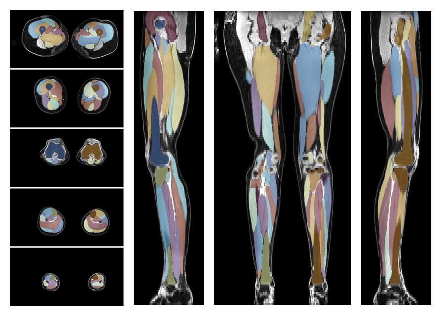 Overlay of automated muscle segmentation labels on dixon water image.